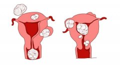 子宫肌瘤的病因主要是哪些